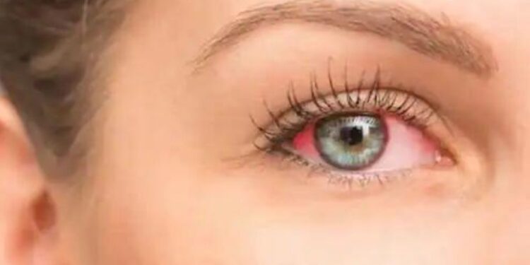 जळगाव जिल्ह्यात डोळे येण्याची साथ रूग्णसंख्येत होतेय वाढ, बचावासाठी प्रशासनाने केले ‘हे’ आवाहन 